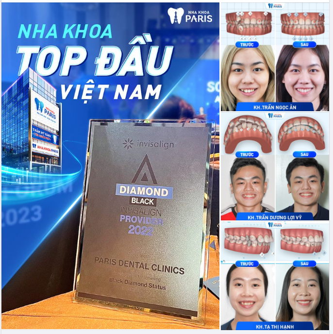 NIỀNG RĂNG AN TOÀN - HIỆU QUẢ - THẨM MỸ