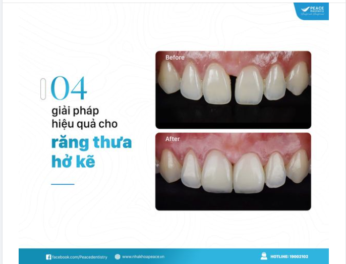 RĂNG THƯA, HỞ KẼ  CÁC PHƯƠNG PHÁP KHẮC PHỤC HIỆU QUẢ