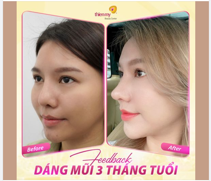 Kết quả siêu đẹp sau 3 tháng nâng mũi  Bấm xem ngay