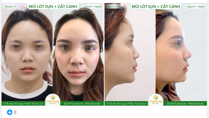Chiếc mũi nhìn từ phía trước không thấy sóng mũi, trông như thể ai đó đắp đại chóp và cánh mũi vào là xong.