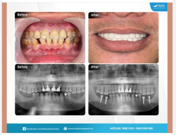 Ca lâm sàng cấy ghép 4 đơn vị implant và thẩm mỹ răng sứ giúp khôi phục trọn vẹn chức năng ăn nhai, đồng thời nâng cao thẩm mỹ nụ cười cho khách hàng