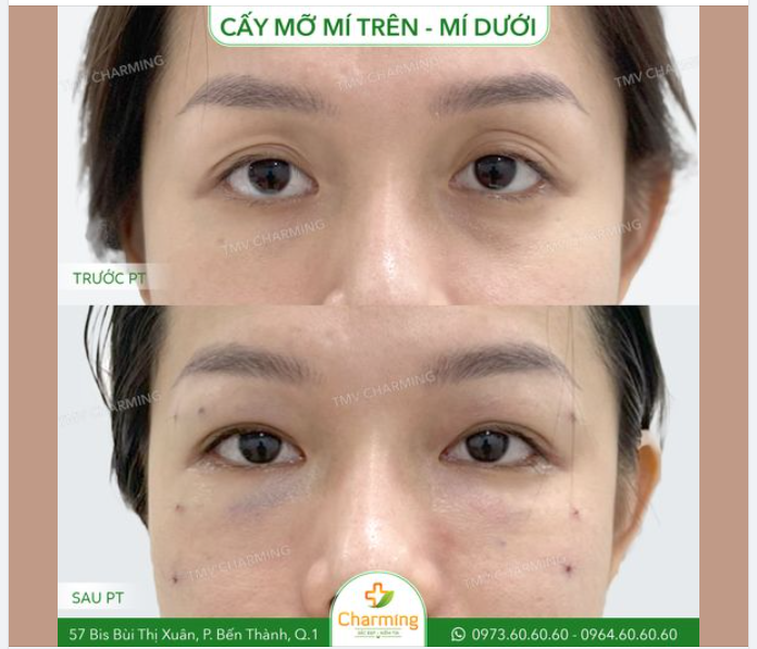 Đối với vấn đề về mí mắt của chúng ta mắt có thể dùng một câu rất thích hợp để mô tả: "Người lớn lo dư, người nhỏ lo thiếu"
