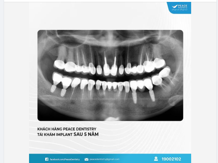 TÁI KHÁM IMPLANT BỀN VỮNG SAU 5 NĂM MINH CHỨNG ĐIỀU GÌ?