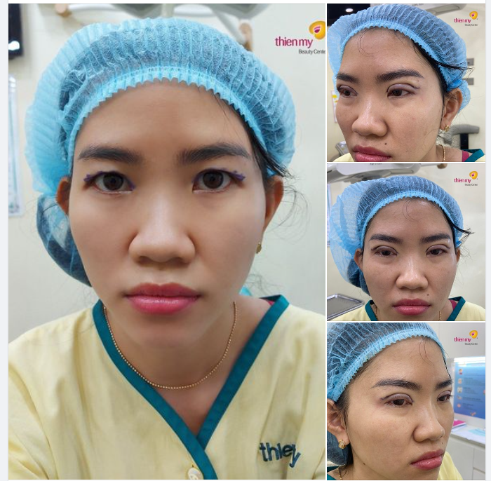 Cận cảnh chân thực nhất trước  sau của khách hàng tới Thiện Mỹ thực hiện dịch vụ tạo hình mắt đẹp toàn diện .