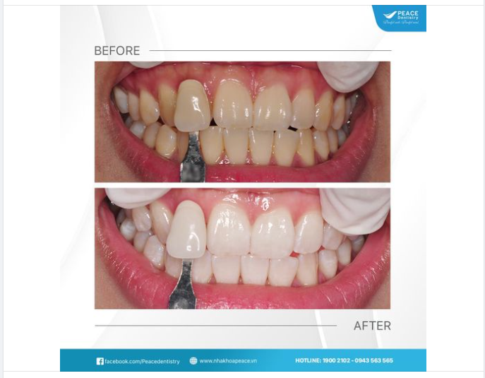 GIẢI ĐÁP MỘT SỐ CÂU HỎI PHỔ BIẾN VỀ TẨY TRẮNG RĂNG:
