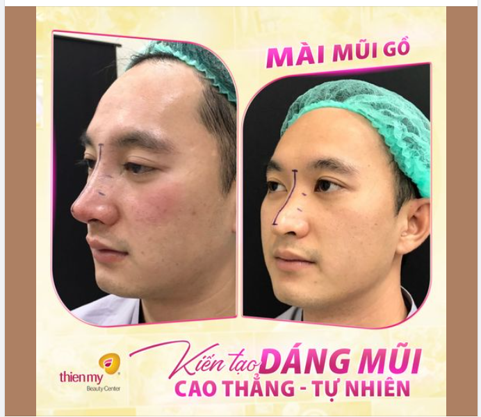 MÀI GỒ XƯƠNG MŨI An toàn – Không ảnh hưởng sức khỏe