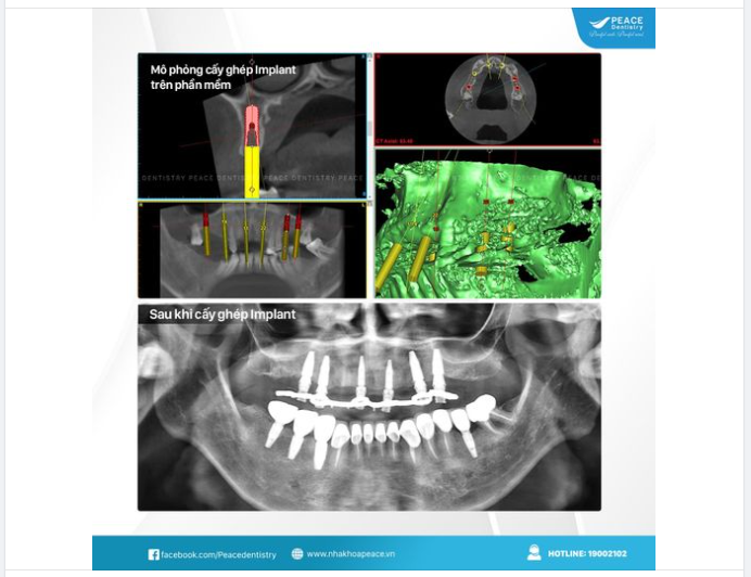 Ca lâm sàng All-on-6 Implant giúp khách hàng lớn tuổi phục hồi tốt chức năng ăn nhai, thẩm mỹ nụ cười và trẻ hóa khuôn mặt.