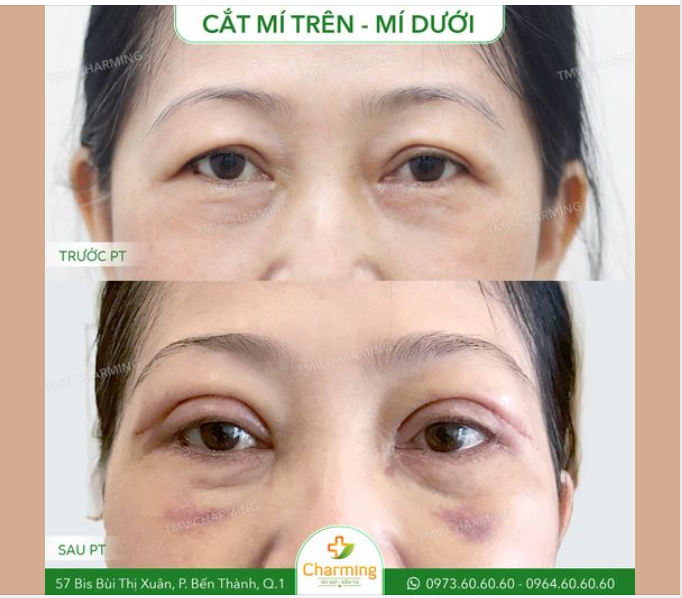 Kẻ thù lớn nhất của tuổi tác là lão hóa. Nạn nhân đầu tiên mà lão hóa hướng đến lúc nào cũng là đôi mắt.
