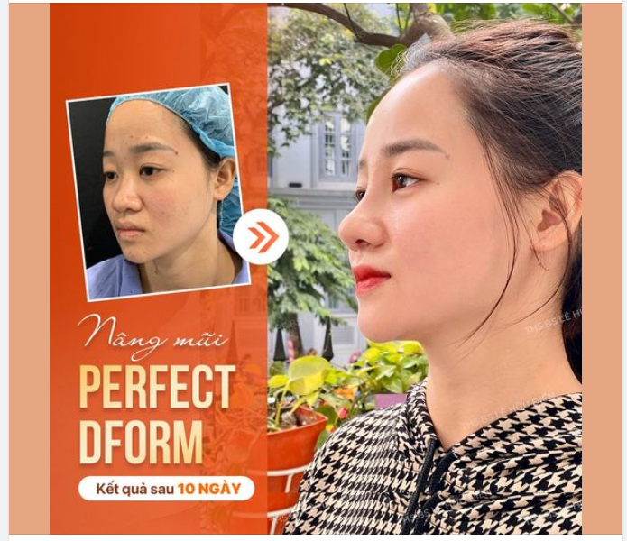 Mũi thấp, to thô  Chỉ 45P mũi cao thẳng, tự nhiên, thăng hạng nhan sắc