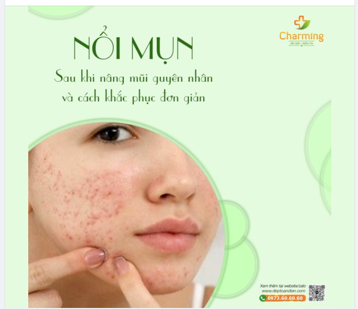 NỔI MỤN SAU KHI NÂNG MŨI - NGUYÊN NHÂN VÀ CÁCH KHẮC PHỤC ĐƠN GIẢN