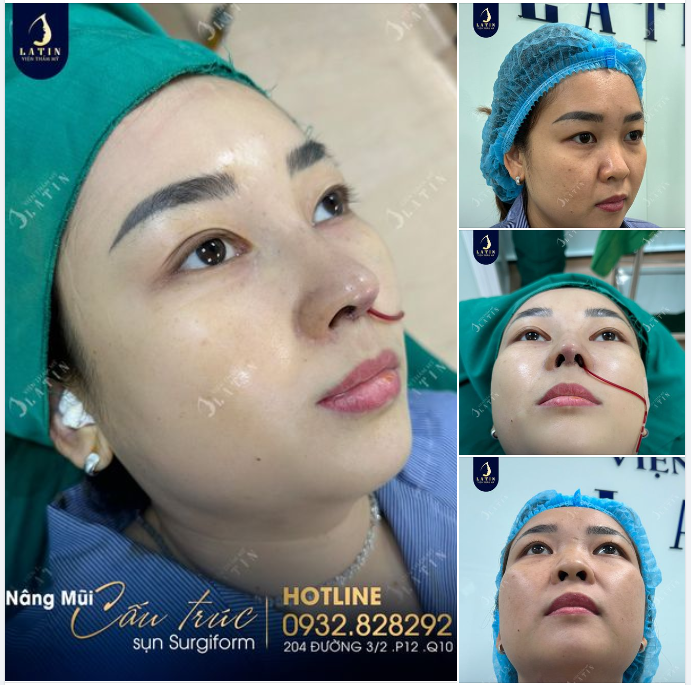 Mũi cấu trúc sụn tai sóng surgiformcho chị gái lần đầu nâng mũi
