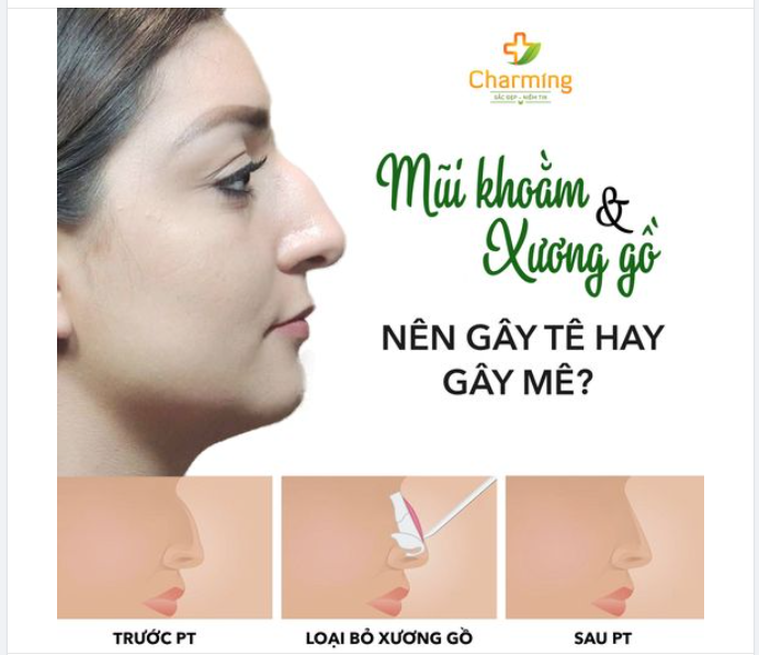SỬA MŨI KHOẰM, XƯƠNG GỒ NHIỀU NÊN PHẪU THUẬT GÂY TÊ HAY GÂY MÊ?