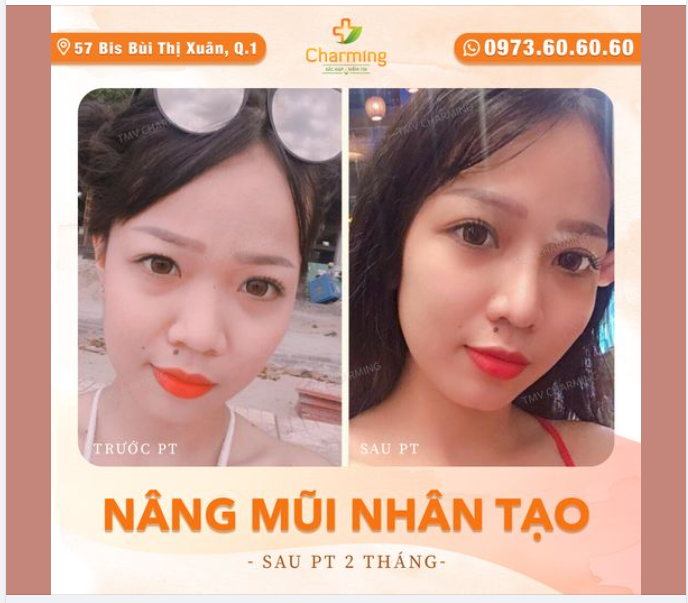 Lâu thiệt là lâu mới có được tấm ảnh feedback mũi nhân tạo nên phải khoe ngay để cả nhà xem cho nóng