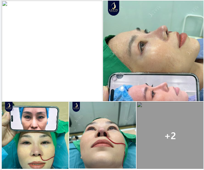 Tại sao nhiều chị em tin tưởng nâng mũi, sửa mũi tại Latin