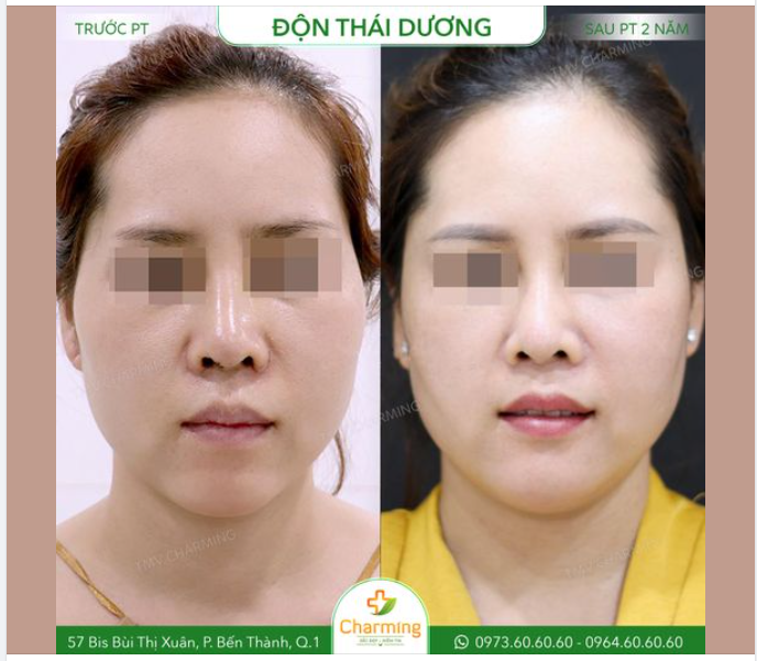 Nếu bạn chưa hình dung ra vấn đề trên khuôn mặt trước khi phãu thuật của vị khách này thì hãy để ý đến phần thái dương nhé.