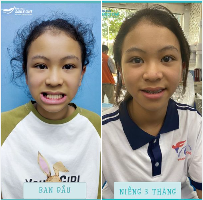 Sự thay đổi một ca khớp cắn ngược sau 3 tháng của bé Hoàng Hà Linh
