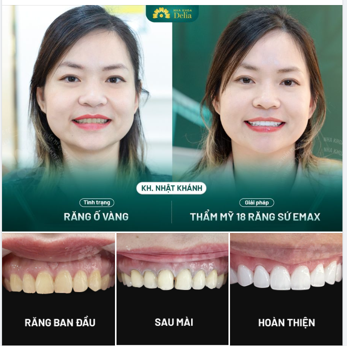 Chỉ sau 48H đồng hành, chị Khánh đã thành công có được nụ cười sáng khỏe, hoàn mỹ như mong đợi.