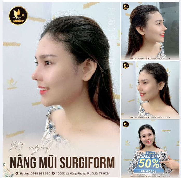10 NGÀY NÂNG MŨI SURGIFORM