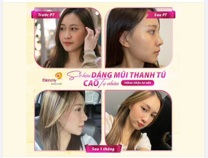 CẬP NHẬP KẾT QUẢ NÂNG MŨI SAU 1 THÁNG CỦA CÔ NÀNG 2K1