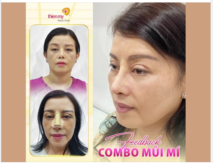 Cô khách hàng rạng rỡ và tràn đầy hạnh phúc với diện mạo mới sau khi thực hiện combo cắt mí + nâng mũi tại Thiện Mỹ.