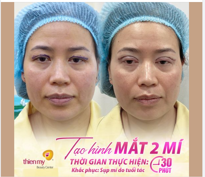Hình ảnh khách hàng sau khi CẮT MÍ TẠI THIỆN MỸ