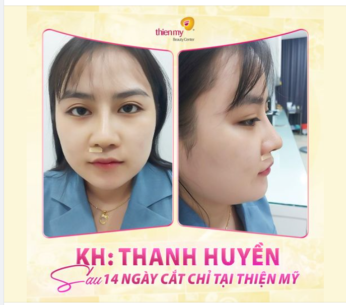 Diện mạo mới xinh đẹp của chị KH sau khi thực hiện nâng mũi tại Thiện Mỹ