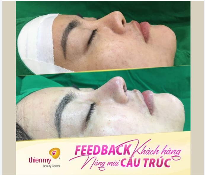 NÂNG MŨI TẠI THIỆN MỸ = Mũi cao thon, an toàn, không lo biến chứng.