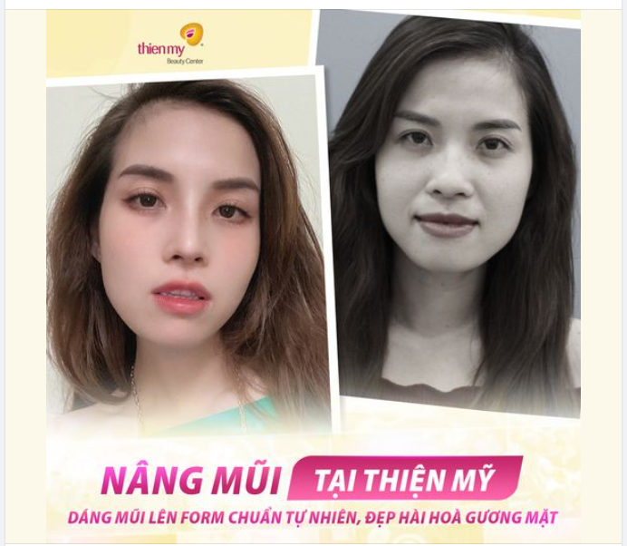Nhan sắc thăng hạng sau khi nâng mũi – Tiết kiệm chi phí khi làm đẹp tại Thiện Mỹ