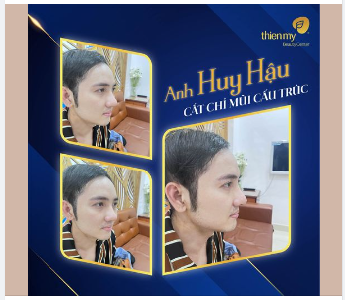 Feedback thế này đủ chân thật chưa ​​​​​​​ Nâng mũi xong về ngủ ngon, không đau, vẫn đi làm bình thường nha anh em!
