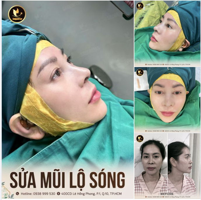 ĐẸP MÊ MẨN SAU KHI SỬA MŨI LỘ SÓNG