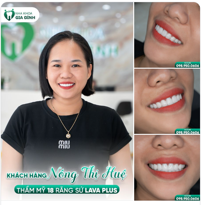 HẠNH PHÚC NGẬP TRÀN TỪ KHI THAY ĐỔI NỤ CƯỜI