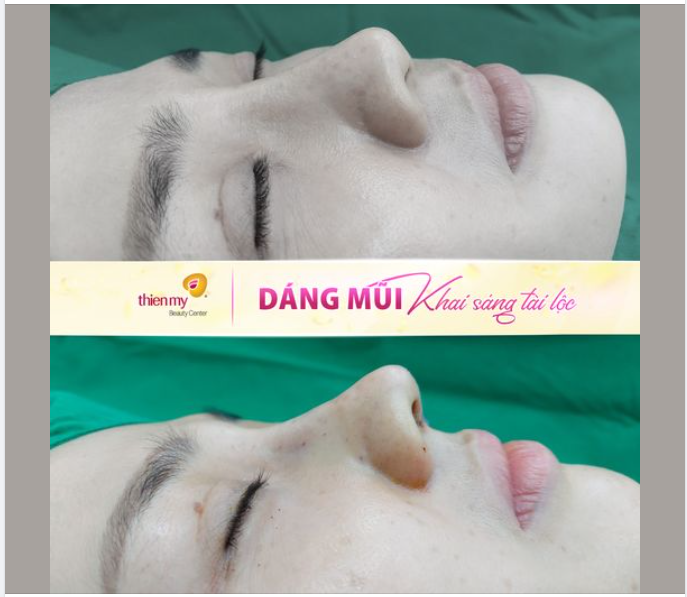 NÂNG MŨI PHONG THỦY - THAY TƯỚNG ĐỔI VẬN