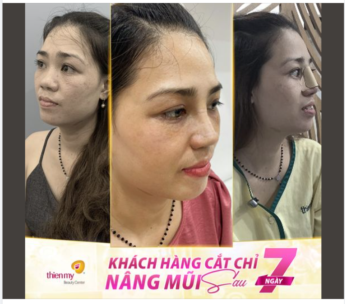 BẤT NGỜ TRƯỚC DIỆN MẠO XINH ĐẸP CỦA KH SAU 7 NGÀY CẮT CHỈ NÂNG MŨI