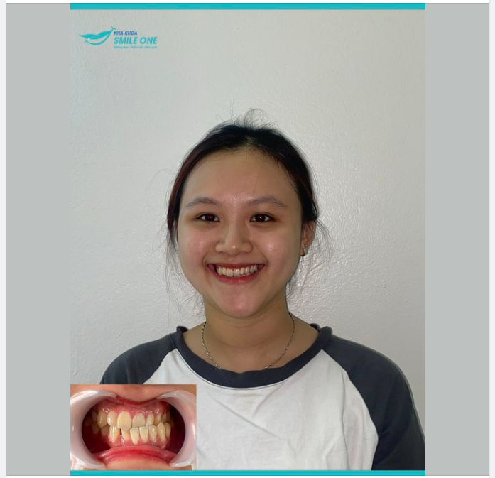 Chào mừng Hoàng Ánh đến với Team niềng răng Smile One