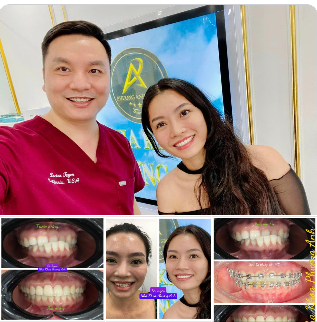 Chúc mừng cô gái đã được tháo Niềng với nụ cười tỏa sáng