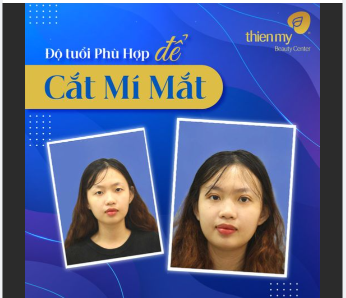 ĐỘ TUỔI PHÙ HỢP ĐỂ CẮT MÍ MẮT