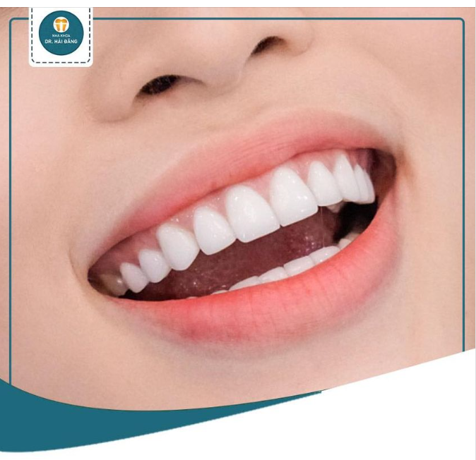 CÔNG NGHỆ RĂNG SỨ TINH XẢO TRƯỜNG TỒN MỌI THỜI GIAN