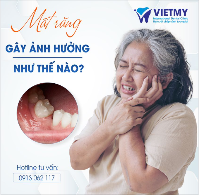 Mất Răng Gây Ảnh Hưởng Như Thế Nào? Đọc Ngay Để Hiểu Rõ Hơn!"