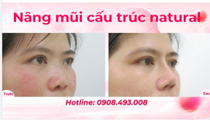 NÂNG MŨI GIÁ SIÊU LỜI MỜI KHÁCH HÀNG VÀO XEM