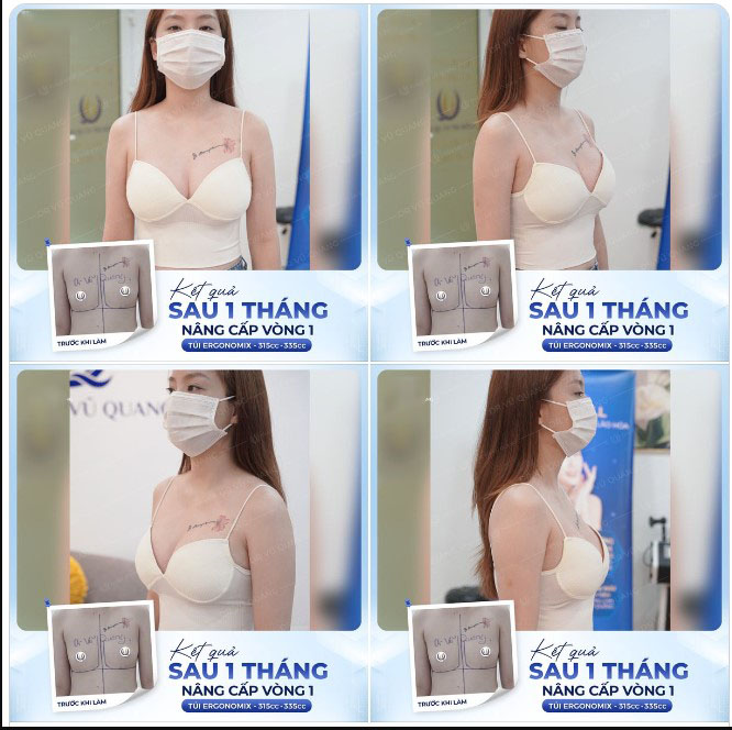 Hình ảnh nâng ngực của một khách hàng