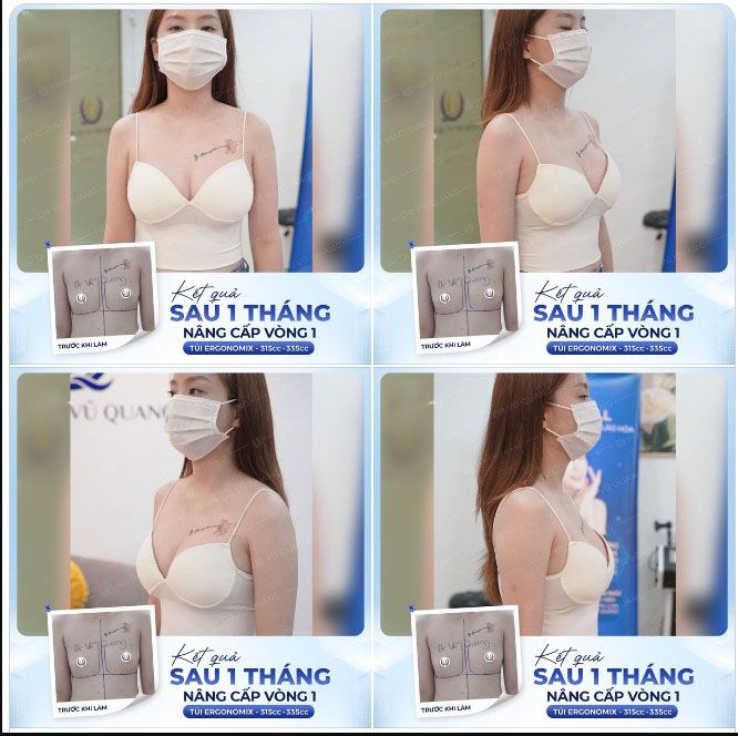 Hình ảnh nâng ngực của một khách hàng