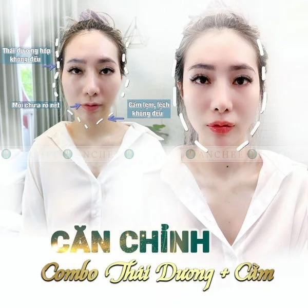 tiem-filler-thai-duong-la-gi