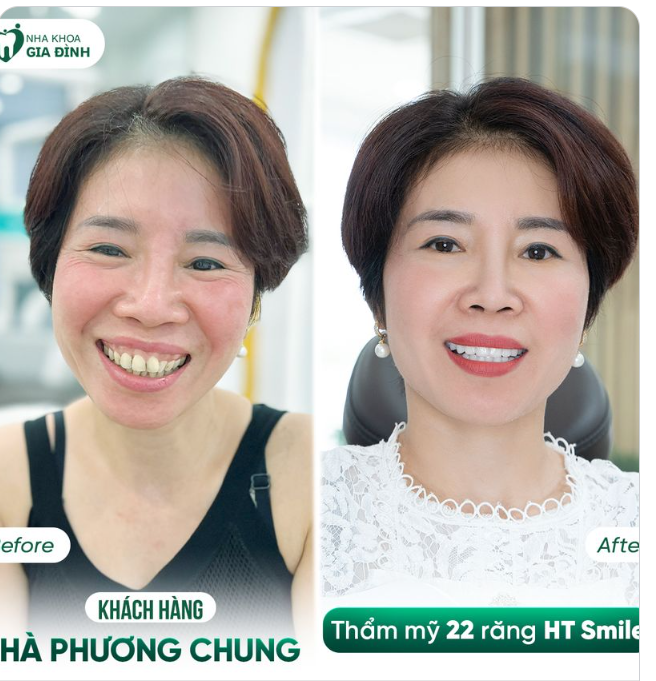 HÀM RĂNG NHƯ THẾ NÀY LẼ RA CHỊ PHẢI ĐI LÀM TỪ LÂU RỒI CHỨ KHÔNG PHẢI ĐỂ ĐẾN BÂY GIỜ