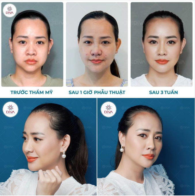 SỞ HỮU NHAN SẮC “VẠN NGƯỜI MÊ” SAU 1 THÁNG THẨM MỸ