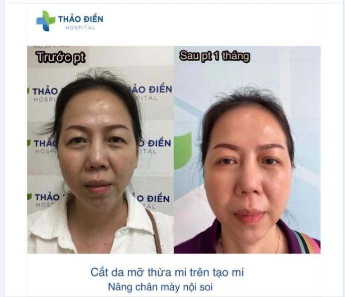 CẮT MÍ ​​​​​​​ Sợ đau, sợ lệch, sợ kết quả không như ý