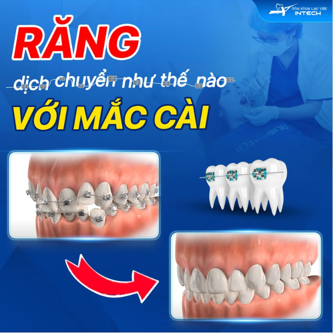 Làm thế nào mà mắc cài có thể khiến răng bạn dịch chuyển?