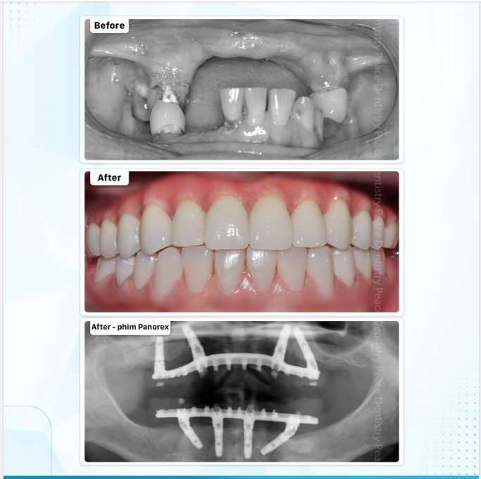 IMPLANT TOÀN HÀM