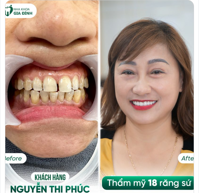 CẢI VẬN RĂNG THƯA - ĐÓN MƯA TÀI LỘC