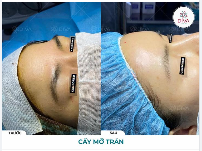 SAU TIÊM MỠ COLEMAN TRÁN CÓ ĐẸP NGAY KHÔNG?