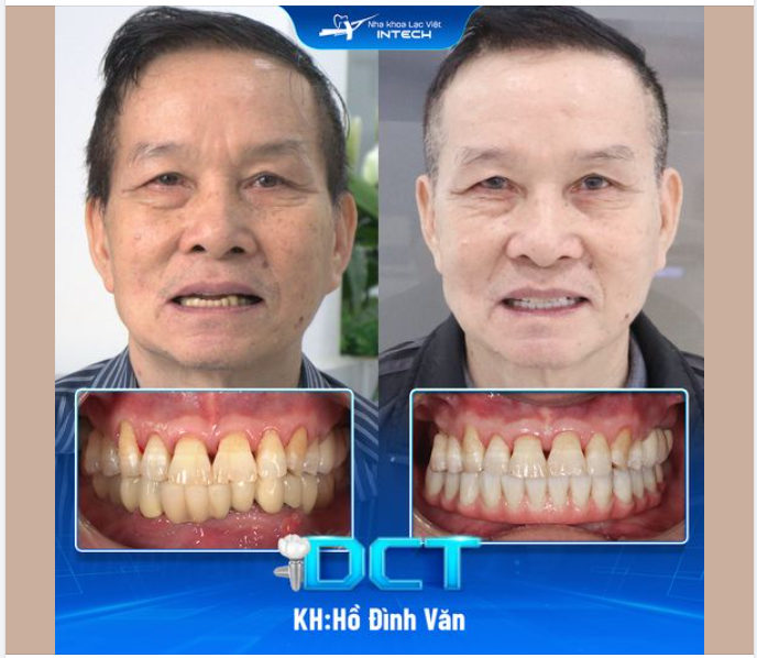 U80 QUYẾT TÂM TRỒNG IMPLANT VÌ “20 NĂM NAY ĂN KHÔNG BIẾT NGON”!
